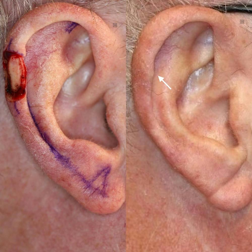 MOHS & Reconstruction Surgery Before & After Gallery - Patient 116766313 - Image 1