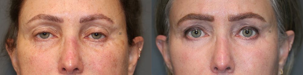  EnigmaLift - Upper Eyelid Surgery Before & After Gallery - Patient 116766437 - Image 1