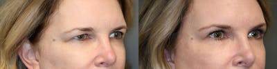  EnigmaLift - Upper Eyelid Surgery Before & After Gallery - Patient 119125905 - Image 1