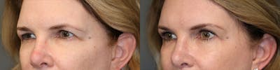  EnigmaLift - Upper Eyelid Surgery Before & After Gallery - Patient 119125905 - Image 2
