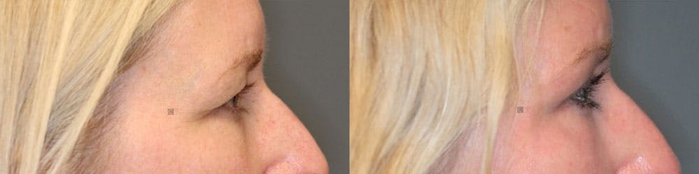 EnigmaLift - Brow Lift Before & After Gallery - Patient 119125952 - Image 3