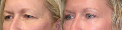  EnigmaLift - Upper Eyelid Surgery Before & After Gallery - Patient 119125963 - Image 4