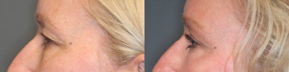 EnigmaLift - Brow Lift Before & After Gallery - Patient 119125952 - Image 5