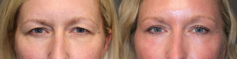 EnigmaLift - Brow Lift Before & After Gallery - Patient 119125952 - Image 1