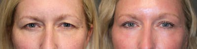 EnigmaLift - Brow Lift Before & After Gallery - Patient 119125952 - Image 1