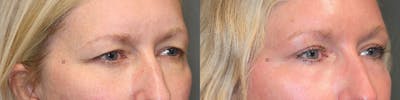 EnigmaLift - Brow Lift Before & After Gallery - Patient 119125952 - Image 2