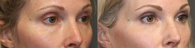 ÔPTIMized Facial Fat Transfer Before & After Gallery - Patient 119125994 - Image 2