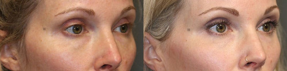 ÔPTIMized Facial Fat Transfer Before & After Gallery - Patient 119125994 - Image 2