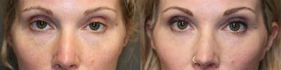 Facial Fat Transfer Before & After Gallery - Patient 119125994 - Image 1