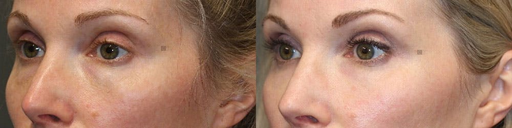ÔPTIMized Facial Fat Transfer Before & After Gallery - Patient 119125994 - Image 3