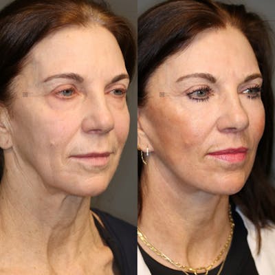 EnigmaLift - Facelift Before & After Gallery - Patient 119126031 - Image 2