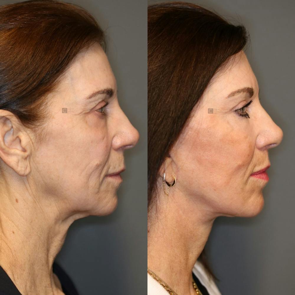 Facial Fat Transfer Gallery - Patient 119126045 - Image 3