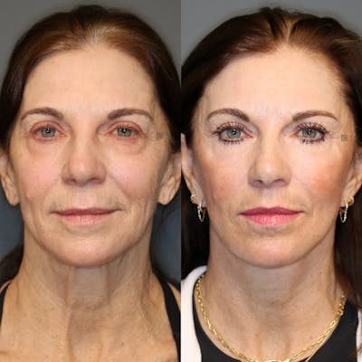 EnigmaLift - Neck Lift Before & After Gallery - Patient 119126032 - Image 1