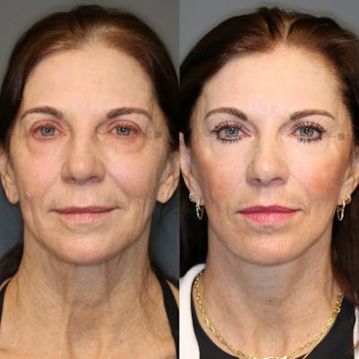 facelift before and after picture