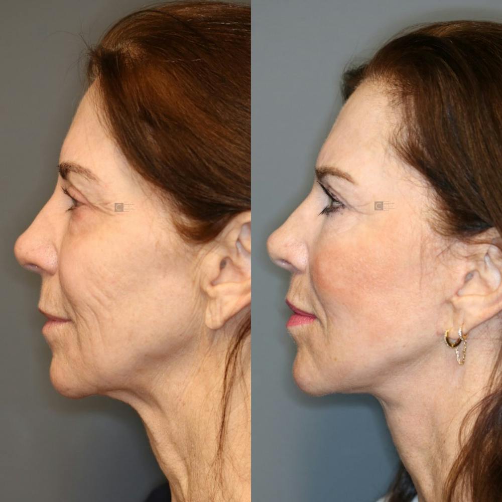 LoveLift - Lip Lift Before & After Gallery - Patient 119126144 - Image 4