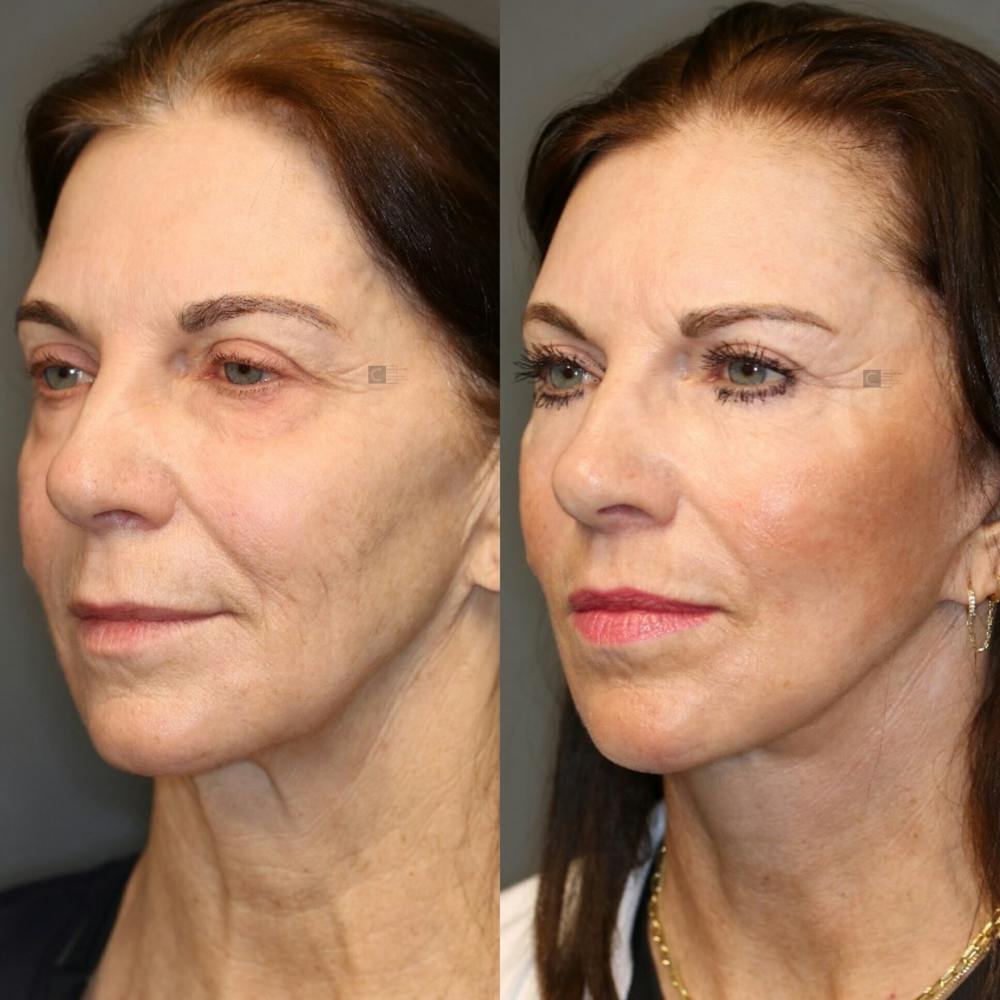 ÔPTIMized Facial Fat Transfer Before & After Gallery - Patient 119126045 - Image 5