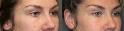 EnigmaLift - Eye Bag Removal Gallery - Patient 119126237 - Image 1