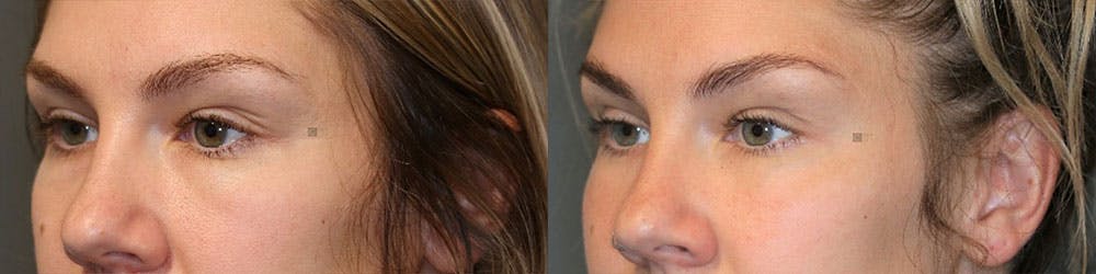 EnigmaLift - Eye Bag Removal Before & After Gallery - Patient 119126237 - Image 2