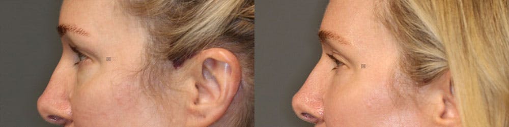 ÔPTIMized Laser Cocktail Before & After Gallery - Patient 119126280 - Image 3