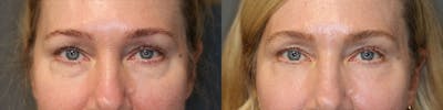 ÔPTIMized Laser Cocktail Before & After Gallery - Patient 119126280 - Image 1