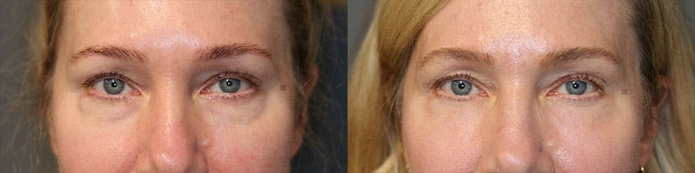 ÔPTIMized Laser Cocktail Before & After Gallery - Patient 119126280 - Image 1