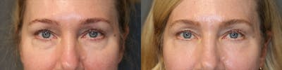 EnigmaLift - Eye Bag Removal Before & After Gallery - Patient 119126278 - Image 1