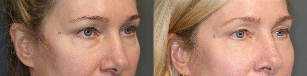 EnigmaLift - Eye Bag Removal Before & After Gallery - Patient 119126278 - Image 2