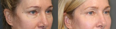 ÔPTIMized Laser Cocktail Before & After Gallery - Patient 119126280 - Image 2