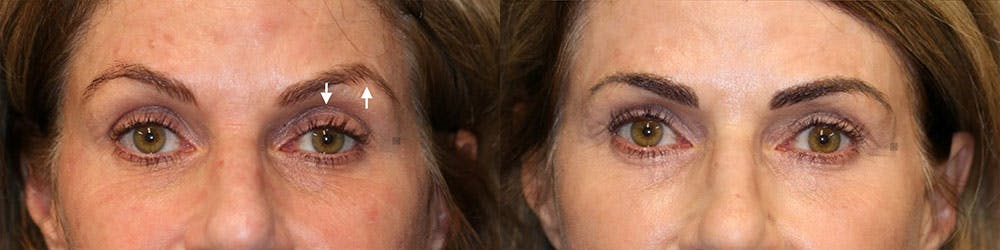 EnigmaLift - Brow Lift Before & After Gallery - Patient 119126293 - Image 1