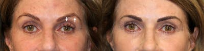 EnigmaLift - Brow Lift Before & After Gallery - Patient 119126293 - Image 1