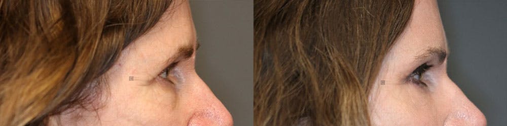  EnigmaLift - Upper Eyelid Surgery Before & After Gallery - Patient 119127096 - Image 3