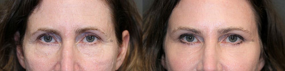  EnigmaLift - Upper Eyelid Surgery Before & After Gallery - Patient 119127096 - Image 1
