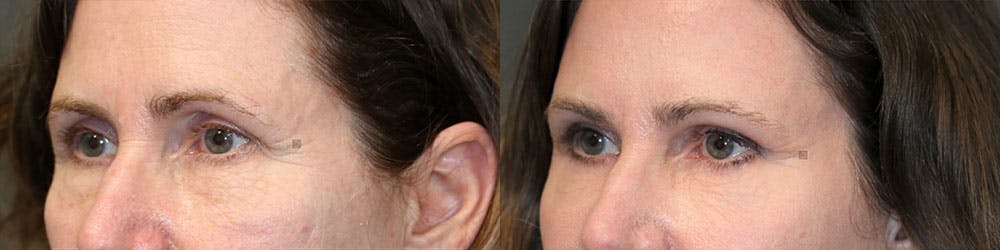  EnigmaLift - Upper Eyelid Surgery Before & After Gallery - Patient 119127096 - Image 4