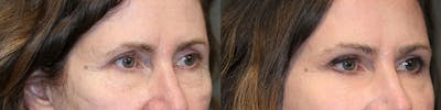 ÔPTIMized Laser Cocktail Before & After Gallery - Patient 119127099 - Image 2