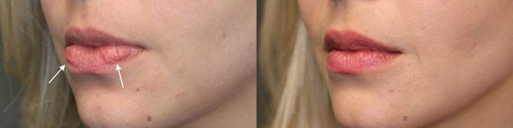 Micro-Structural Lip Augmentation Before & After Gallery - Patient 119127144 - Image 2