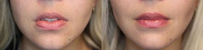 Micro-Structural Lip Augmentation Before & After Gallery - Patient 119127144 - Image 1