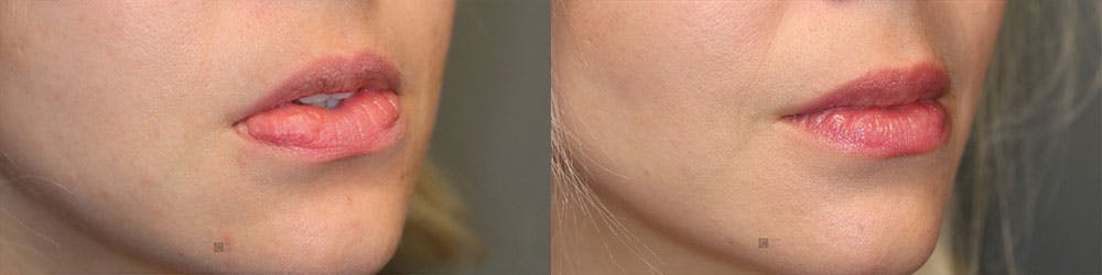 Micro-Structural Lip Augmentation Before & After Gallery - Patient 119127144 - Image 4