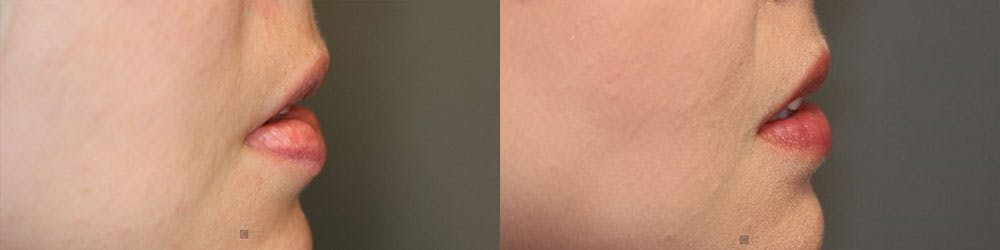 Dermal Fillers Before & After Gallery - Patient 119127169 - Image 4
