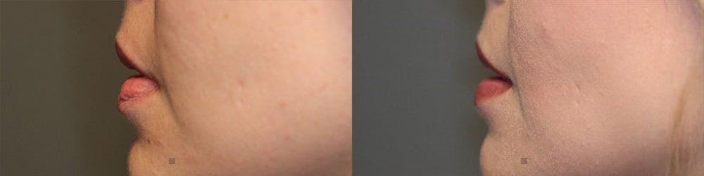 Micro-Structural Lip Augmentation Before & After Gallery - Patient 119127144 - Image 3