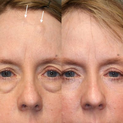 EnigmaLift - Brow Lift Before & After Gallery - Patient 119127195 - Image 1