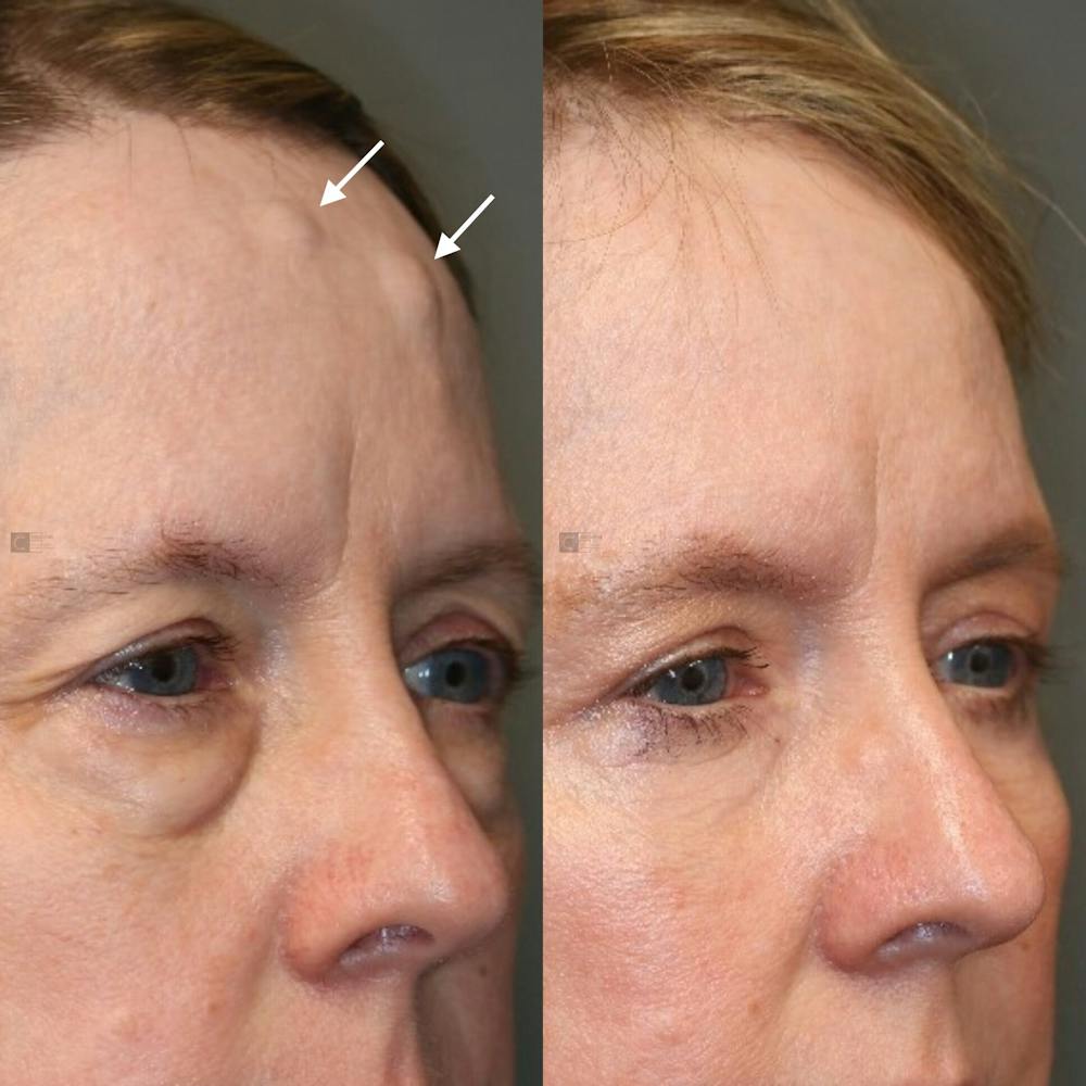  EnigmaLift - Upper Eyelid Surgery Before & After Gallery - Patient 119127184 - Image 2