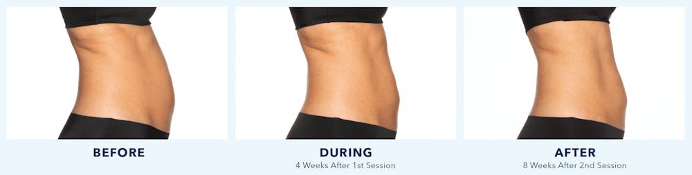 Coolsculpting Before & After Gallery - Patient 121257395 - Image 1