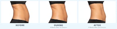 Coolsculpting Before & After Gallery - Patient 121257395 - Image 1