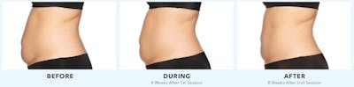 Coolsculpting Gallery - Patient 121257396 - Image 1