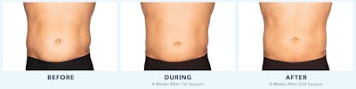 Coolsculpting Before & After Gallery - Patient 121257397 - Image 1