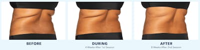 Coolsculpting Before & After Gallery - Patient 121257398 - Image 1