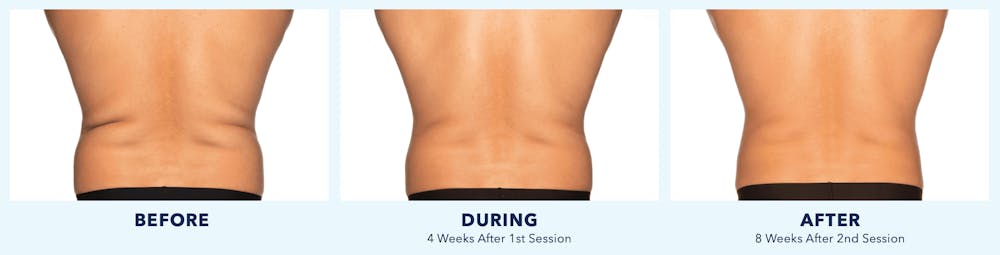 Coolsculpting Gallery - Patient 121257399 - Image 1