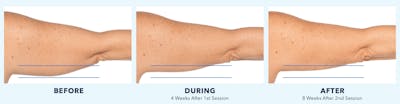 Coolsculpting Before & After Gallery - Patient 121257400 - Image 1