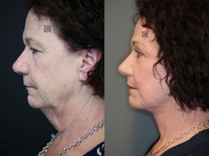 Before and after vidalift for neck