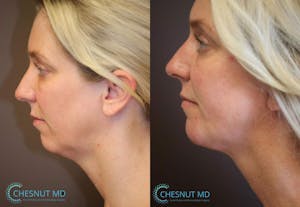 Before and after structural chin augmentation